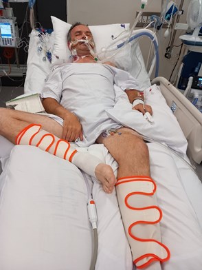 Man in hospital bed with eyes closed and medical equipment attached.