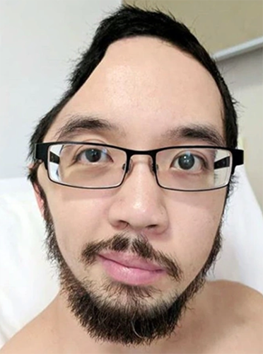 Nathan with part of his skull removed in hospital