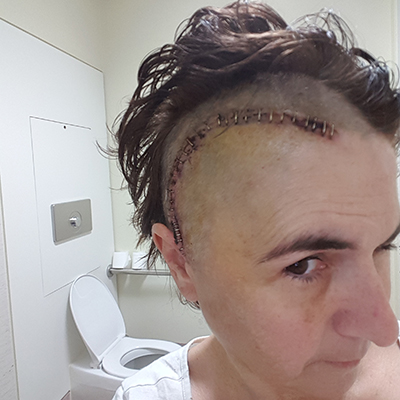Janelle in hospital showing her stitches 
