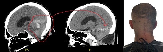 Damian's CT scan and scar at the back of his head